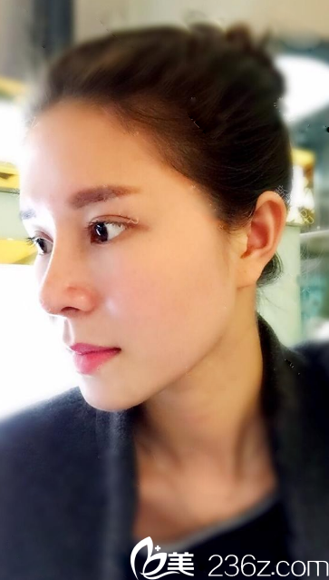 深圳雅涵高山做鼻子怎么样？分享深圳隆鼻大王高山鼻综合案例图片