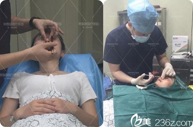 做线雕隆鼻划线和手术过程中