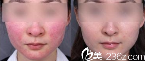 大同美神整形孟庆兰祛红血丝案例 大同美神整形孟庆兰祛红血丝案例