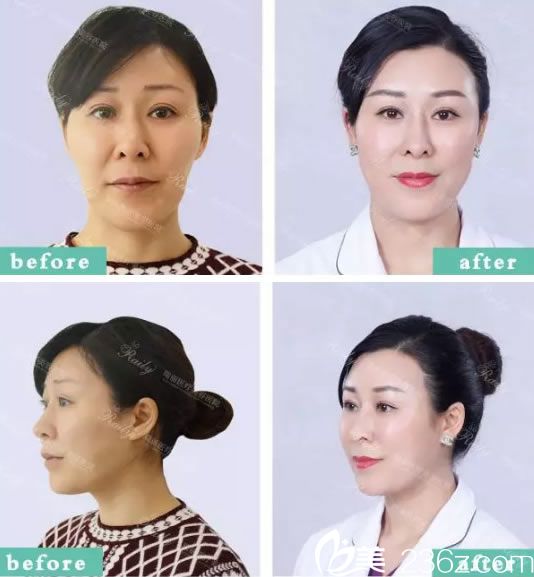 杭州瑞丽员工做自体脂肪填充效果 杭州瑞丽员工做自体脂肪填充效果