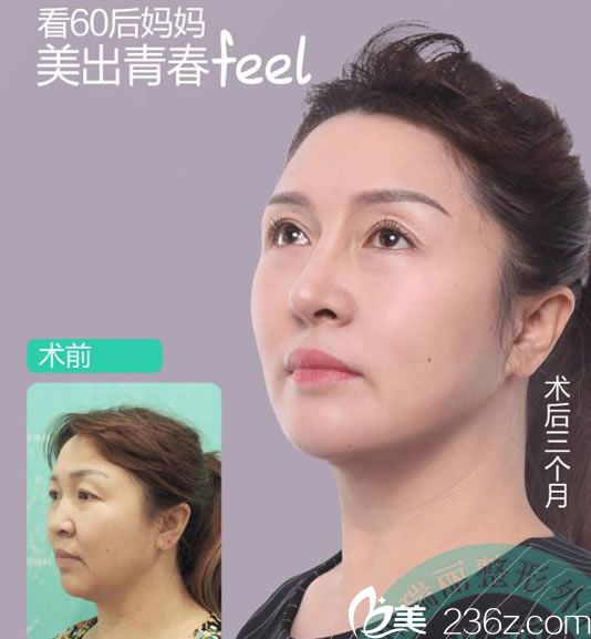 60后妈妈做自体脂肪填充效果 60后妈妈做自体脂肪填充效果