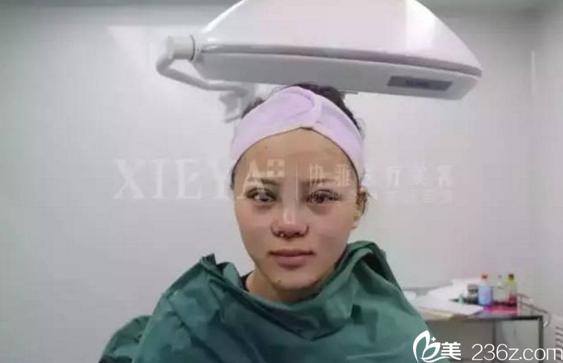 长沙协雅隆鼻+双眼皮真人案例