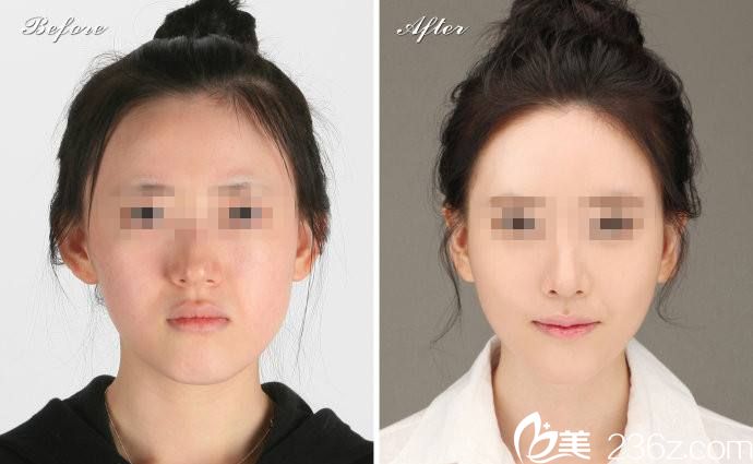 注射玻尿酸前后对比图