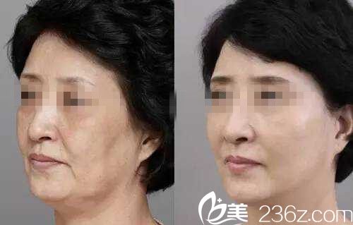 埋蛋白线前后对比图