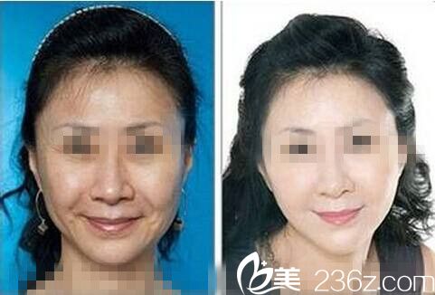 注射瘦脸除皱前后对比图
