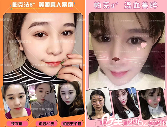 杨迪帕克8度美眼案例 杨迪帕克8度美眼案例