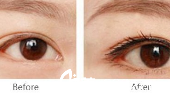 北京煤医整形纹绣案例 北京煤医整形纹绣案例