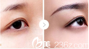 北京煤医整形纹绣案例 北京煤医整形纹绣案例