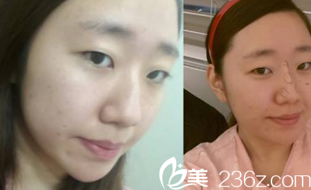 济宁韩美医院隆鼻怎么样？多少钱？真人<span style=