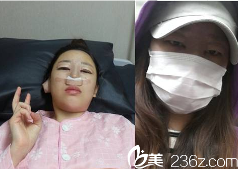 济宁韩美医院隆鼻怎么样？多少钱？真人<span style=