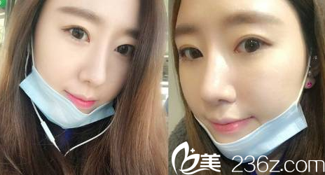 济宁韩美医院隆鼻怎么样？多少钱？真人<span style=