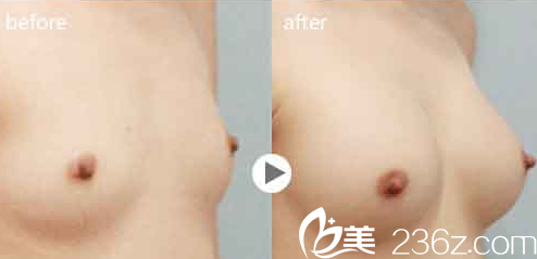 宁夏华美整形何林隆胸真人案例 宁夏华美整形何林隆胸真人案例