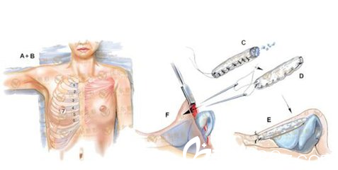 自体肋软骨隆鼻取肋软骨的部位