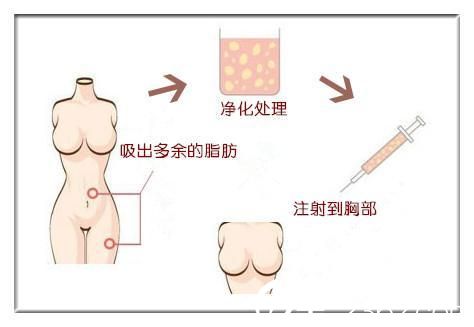 自体脂肪隆胸示意图