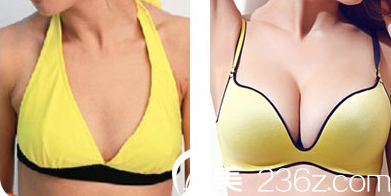 自体脂肪隆胸前后对比图