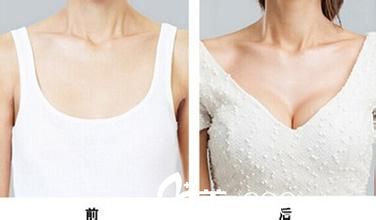 假体隆胸前后对比图