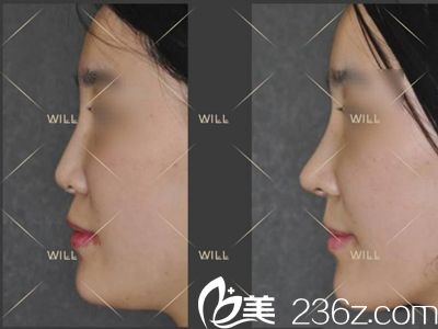 will医院自体软骨鼻综合真人案例