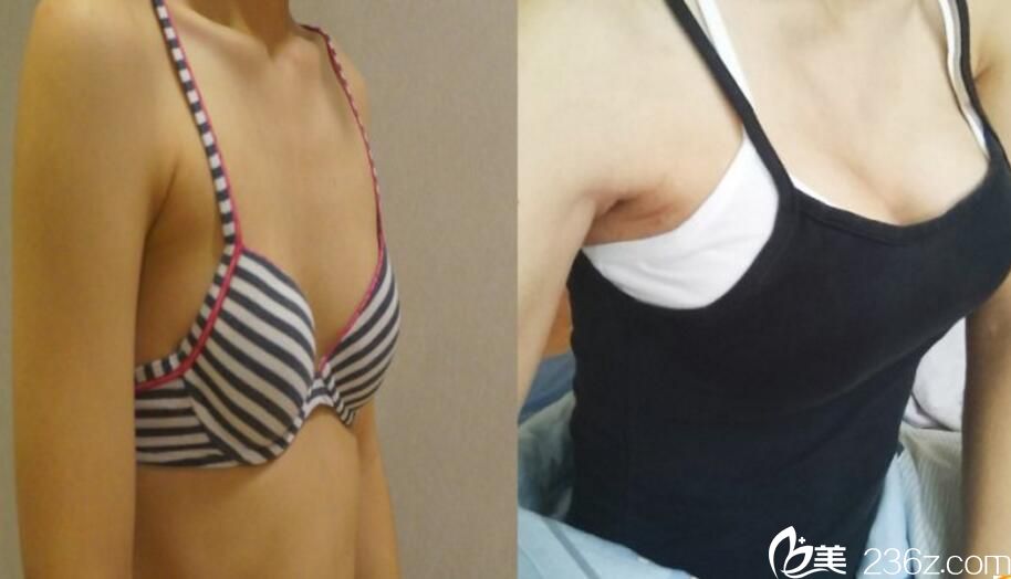 朴珉奭院长手术 - 隆胸前后对比照 朴珉奭院长手术 - 隆胸前后对比照