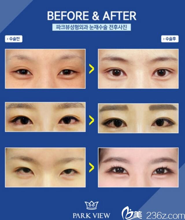 韩国Parkview整形外科双眼皮案例 韩国Parkview整形外科双眼皮案例