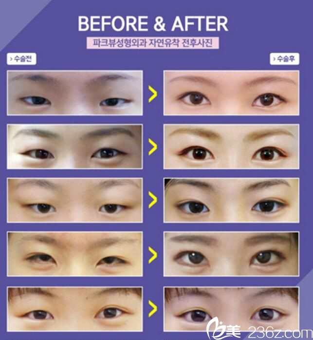 韩国Parkview整形外科做双眼皮好吗