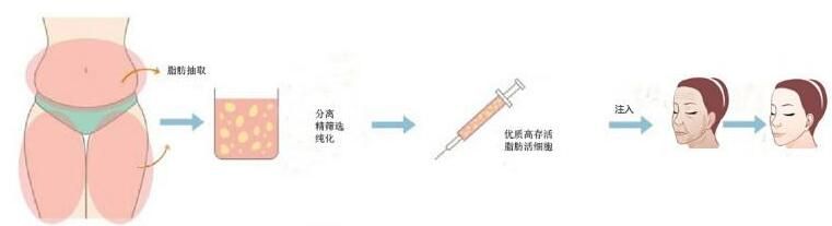 上海交通大学医学院附属仁济医院整形外科陆毅细胞辅助自体脂肪移植