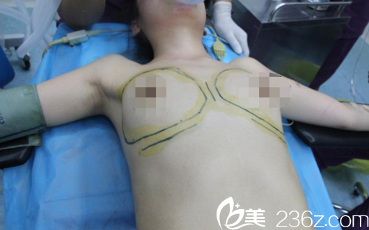 宁夏华美隆胸术中过程 宁夏华美隆胸术中过程