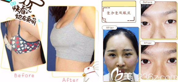 合肥壹加壹<!--<i data=20240703-sp></i>-->丰胸+双眼皮手术案例 合肥壹加壹<!--<i data=20240703-sp></i>-->丰胸+双眼皮手术案例