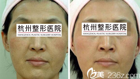 注射除皱效果 注射除皱效果