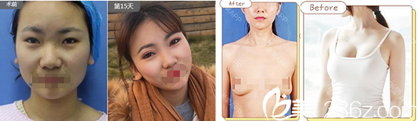 合肥壹加壹甘泉涌双眼皮+丰胸案例 合肥壹加壹甘泉涌双眼皮+丰胸案例