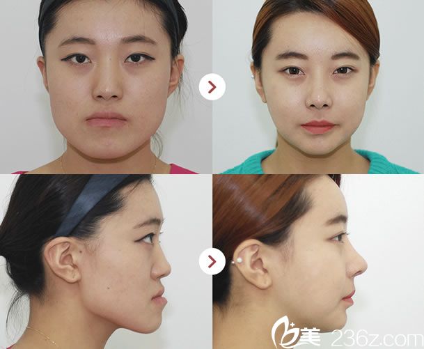 韩国姜永浩院长双鄂手术案例 韩国姜永浩院长双鄂手术案例