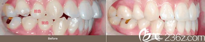 金允宣院长凸嘴牙齿矫正案例 金允宣院长凸嘴牙齿矫正案例