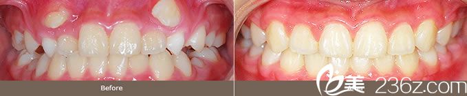 金允宣院长虎牙矫正案例 金允宣院长虎牙矫正案例