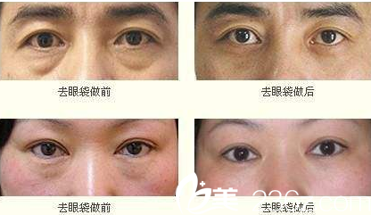 合肥壹加壹高影祛眼袋案例 合肥壹加壹高影祛眼袋案例