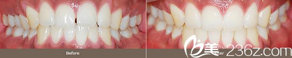 全辉院长门牙缝隙矫正效果 全辉院长门牙缝隙矫正效果
