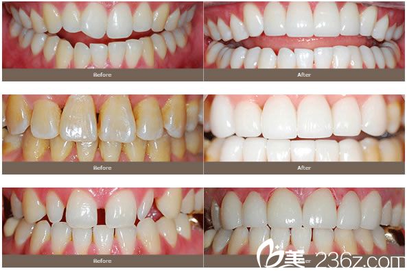 李東奎院长前牙瓷粘结性仿生修复 李東奎院长前牙瓷粘结性仿生修复