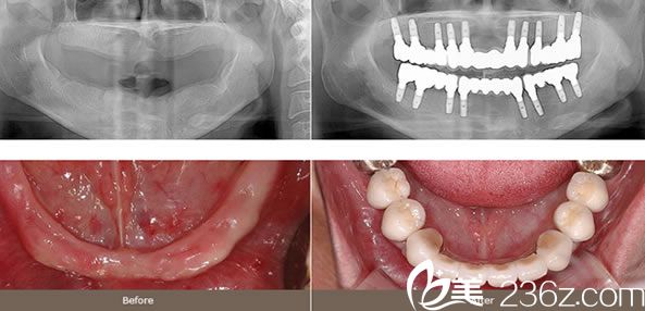 李東奎院长整体植牙案例 李東奎院长整体植牙案例