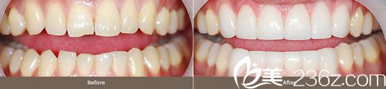 氧化锆生物陶瓷美容冠效果 氧化锆生物陶瓷美容冠效果