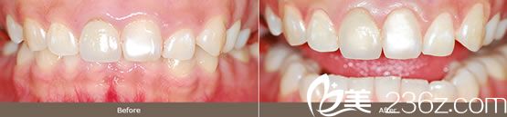 罗英民院长的牙床整形案例 罗英民院长的牙床整形案例