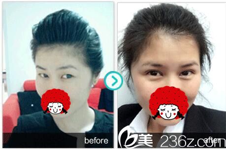 双眼皮加上睑下垂前对后壁 双眼皮加上睑下垂前对后壁