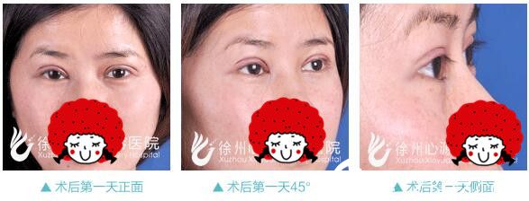 徐州心源做双眼皮术后天 徐州心源做双眼皮术后天