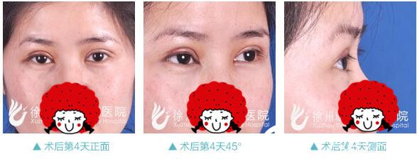 双眼皮术后第四天恢复 双眼皮术后第四天恢复