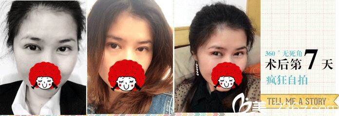 徐州心源双眼皮+上睑下垂矫正案例6980元效果好吗