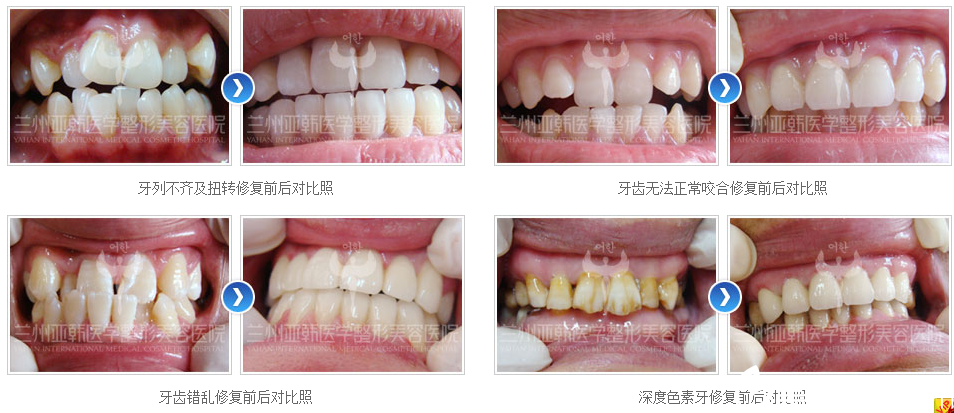 兰州亚韩李伟医生口腔修复案例