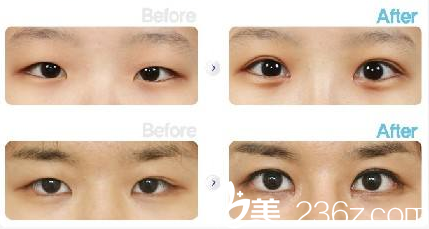 安徽韩美刘冷双眼皮案例对比照片 安徽韩美刘冷双眼皮案例对比照片
