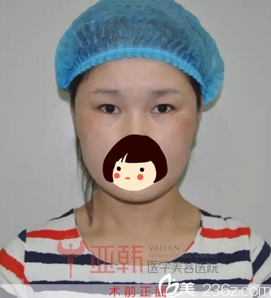兰州亚韩双眼皮术前正面照 兰州亚韩双眼皮术前正面照