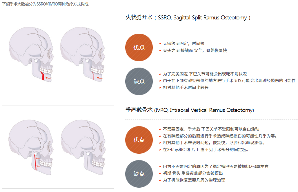 韩国齐娥牙科SSRO下颌手术优缺点