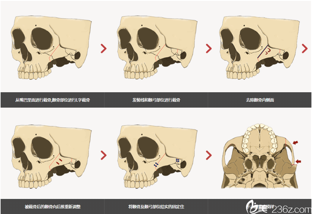 韩国齐娥牙科颧骨手术示意图