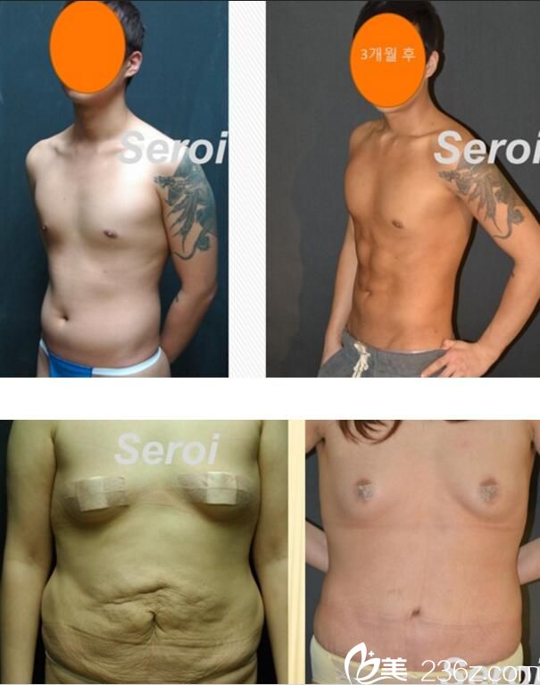 罗钰周吸脂案例 罗钰周吸脂案例