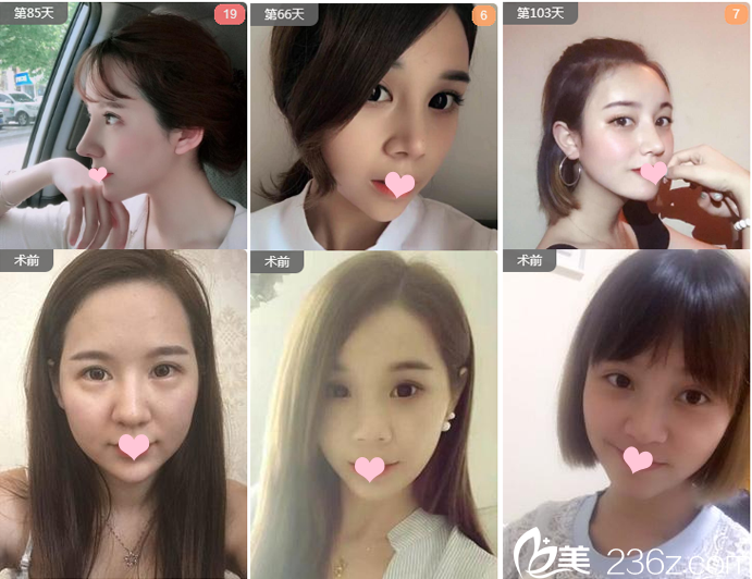 广州艺美整形医院李闯院长隆鼻案例 广州艺美整形医院李闯院长隆鼻案例