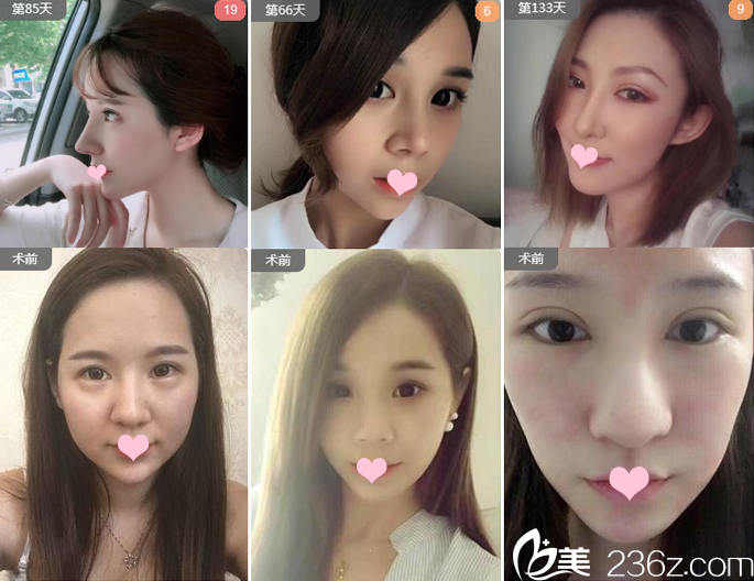 广州艺美李闯隆鼻及鼻修复案例 广州艺美李闯隆鼻及鼻修复案例